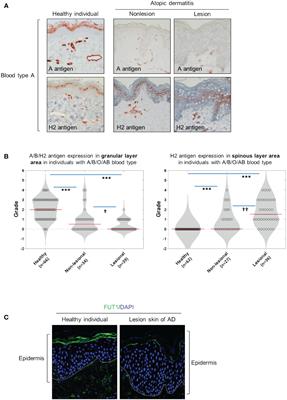 Impact of fucosyltransferase 1-mediated epidermal blood group antigen H on anti-inflammatory response in atopic dermatitis